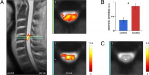 fMRI skeneriu darytos nuotraikos patvirtino realiai jaučiamą fizikinį skausmą.